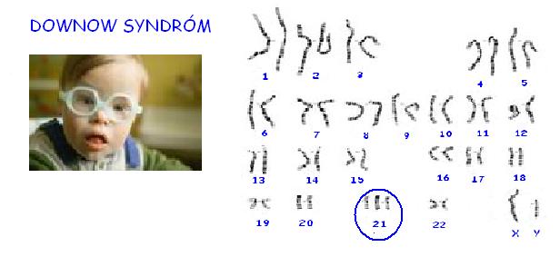 Downov syndrom